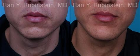 Chin Augmentation in Newburgh, NY | Ran Y. Rubinstein, MD