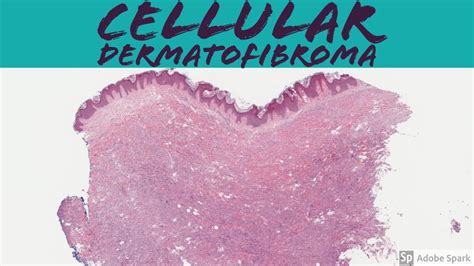 Dermatofibroma Histology