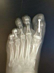 Great Toe Joint Fusion Surgery [Faster Recovery Time Tips!]