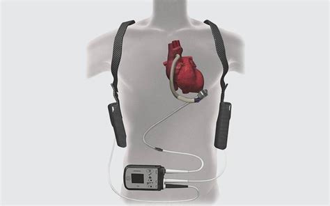 MCS and LVAD Surgery FAQs - Heart Care - Scripps Health