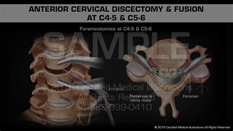 Anterior Cervical Discectomy & Fusion at C4-5 & C5-6 - YouTube