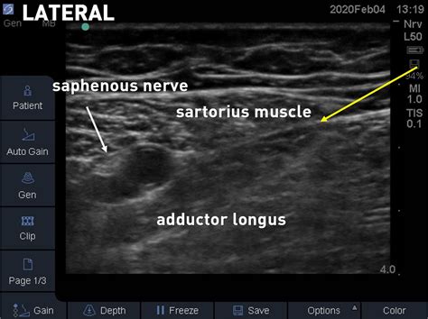 Adductor Canal Nerve Block Ultrasound