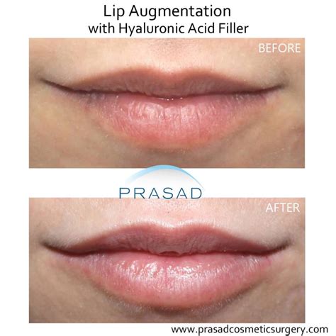 How to Get Natural Looking Lip Fillers - Amiya Prasad MD Blog