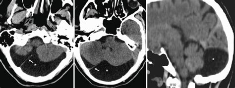 Mega Cisterna Magna and Retrocerebellar Arachnoid Cysts | SpringerLink