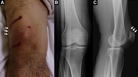 Closed Emergency Department Reduction of a Superior Patellar Dislocation After Blunt Trauma ...