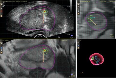 MR/ultrasound fusion guided biopsy of the prostate: a better way to biopsy the prostate | CK Ng ...