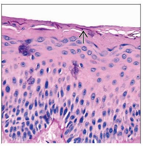 Dermatophytosis | Basicmedical Key