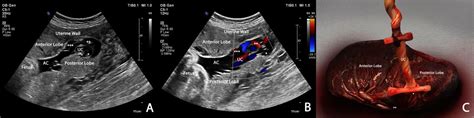 Velamentous Cord Insertion Ultrasound