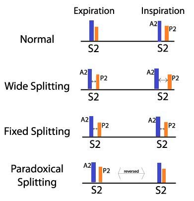 Splitting - Cardiovascular - Medbullets Step 1