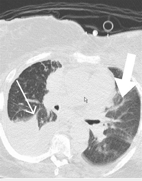 Computed tomography image showing left-loculated pleural effusion ...