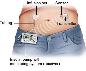 Continuous glucose monitoring (CGM) | informedhealth.org