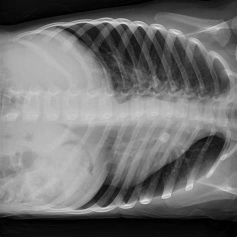 A Screwy Case of Pediatric Shortness of Breath — BROWN EMERGENCY MEDICINE