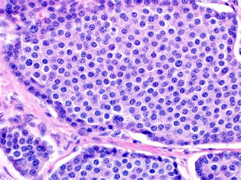 Pathology Outlines - Neuroendocrine tumor