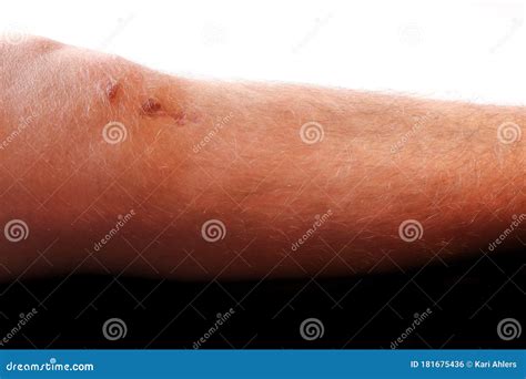 Knee scar from surgery stock photo. Image of painful - 181675436