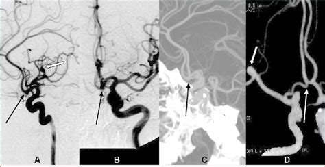 Patient with the right middle cerebral artery (MCA) aneurysm (thick... | Download Scientific Diagram