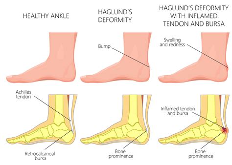 Haglund’s Deformity - James McCormack