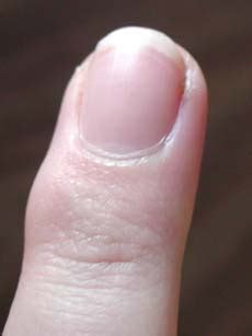 Ingrown Toenail Treatment: Ingrown Fingernail Causes