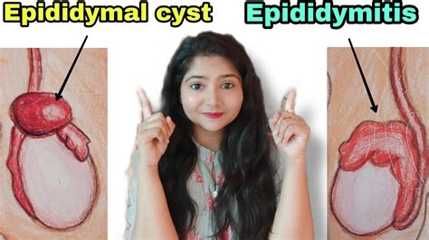 epididymal cyst | epididymitis treatment | Scrotal pain | - YouTube