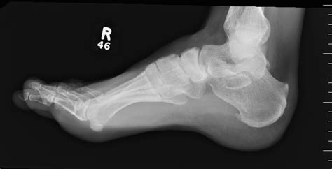 Navicular fractures | The Bone School