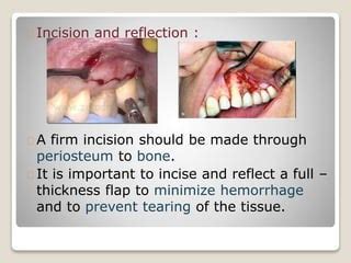 Apicoectomy