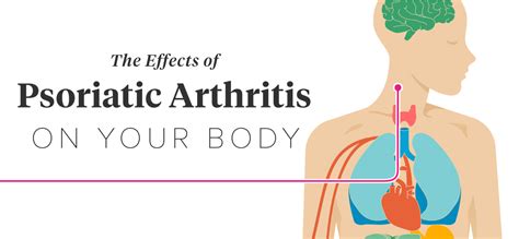 12 Effects of Psoriatic Arthritis on the Body