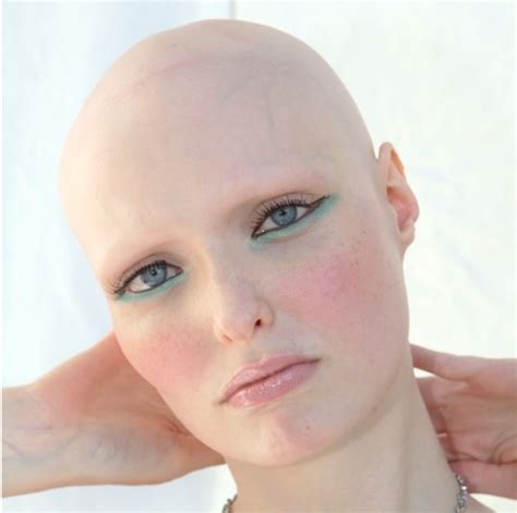 ALOPECIA UNIVERSALIS - My Hair Doctor