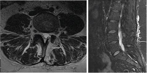 MRI lumbar spine showing postsurgical changes of a left-side ...