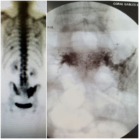 Cureus | Sacral Insufficiency Fractures: Recognition and Treatment in Patients with Concurrent ...