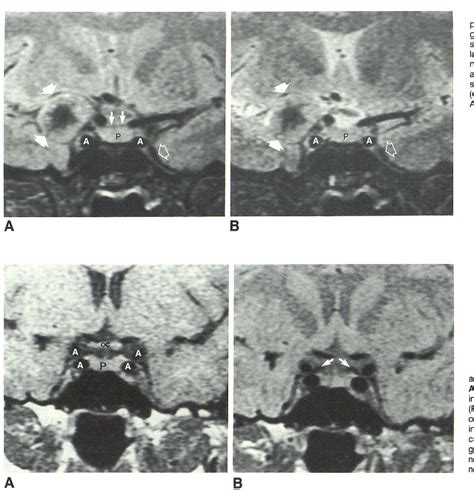 Diaphragma Sellae Mri