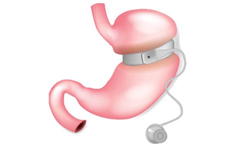 Gastric Band Maintenance - Coffee Regional Bariatric & Metabolic Center