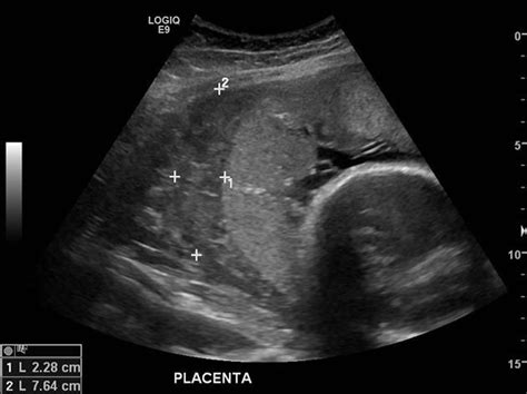 Placental Abruption Ultrasound | Hot Sex Picture