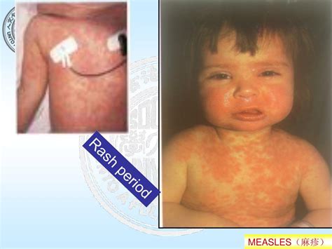 PPT - MEASLES (RUBEOLA) PowerPoint Presentation, free download - ID:6492882