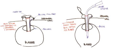 Suprapubic Cystostomy