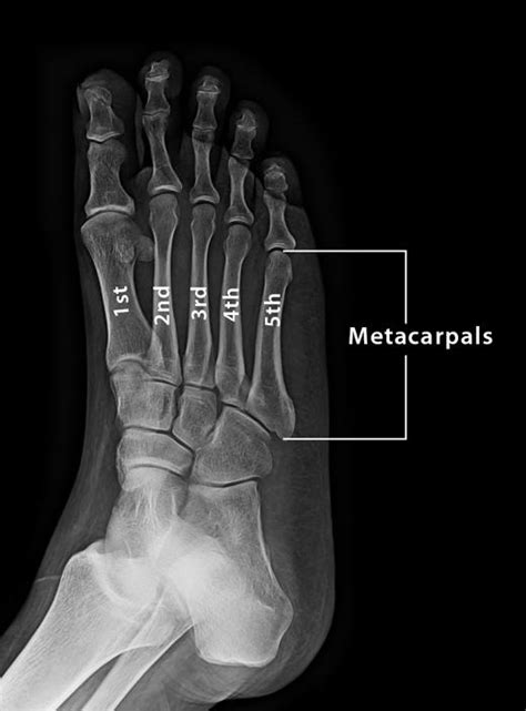 Metatarsal Bones – Definition, Location, Anatomy, & Functions