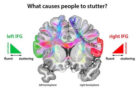 Stuttering: Stop Signals in the Brain Disturb Speech Flow ...