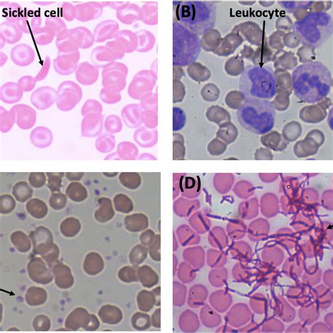 Giemsa stain of a normal blood smear. Cellular features are labeled.... | Download Scientific ...