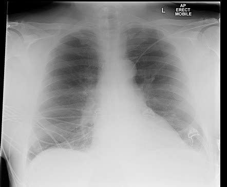 Chest (AP erect view) | Radiology Reference Article | Radiopaedia.org