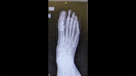 Successful Big Toe Fusion | Hallux Metatarsophalangeal Joint Fusion ...