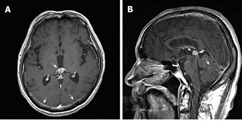 Pineal Gland Sagittal Mri