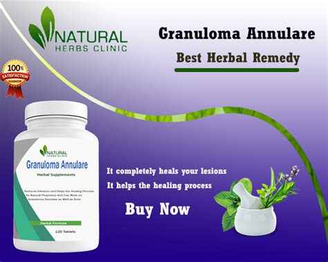 Home Cure for Generalized Granuloma Annulare Treatment Natural