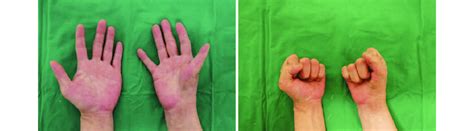 Gross photograph of both hand. Severe thenar muscle atrophy is seen at ...