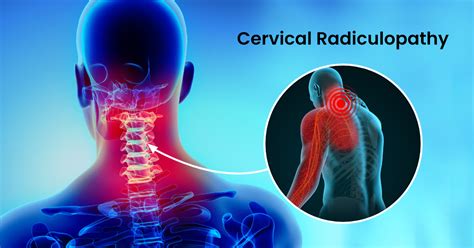 Lumbar Cervical Radiculopathy Scottsdale, AZ Orthopedic, 41% OFF