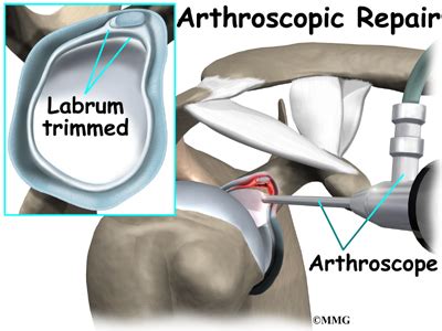 Labral Tears | Osteopathy and Physiotherapy in Northampton