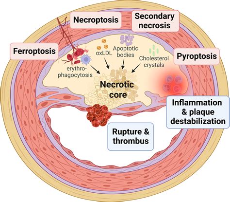 Regulated Necrosis in Atherosclerosis | Arteriosclerosis, Thrombosis, and Vascular Biology