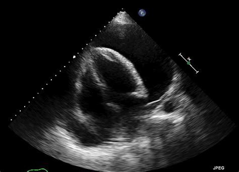 Cureus | Subacute COVID-19 Infection Presenting as Indolent Large Pericardial Effusion