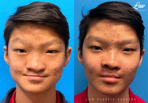 Asian Rhinoplasty Before & After Photos - Law Plastic Surgery