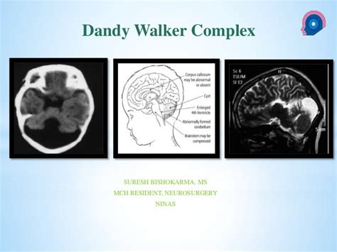 Dandy Walker syndrome