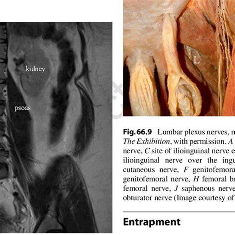 5 Coronal MRI image of the lumbosacral plexus (Image courtesy of Andrea ...