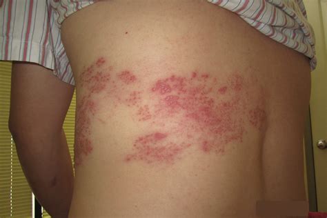 Shingles - Causes, Symptoms, Home Remedies, Treatment