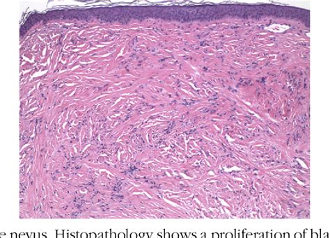 Blue Nevus Histology